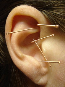 auricular acupuncture